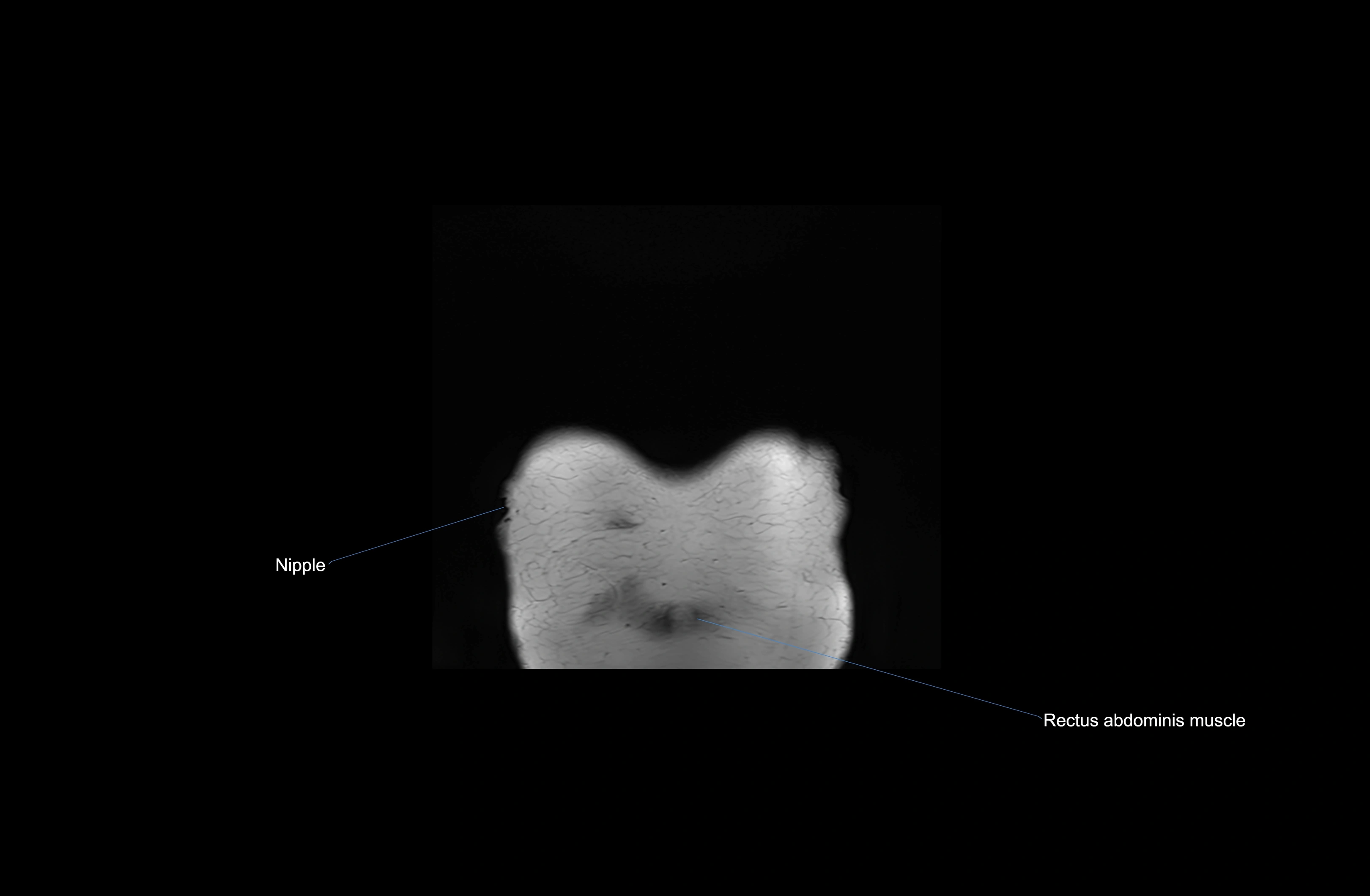 MRI chest (thorax) coronal  cross sectional anatomy 3T radiology  image-img-00001-00001.webp